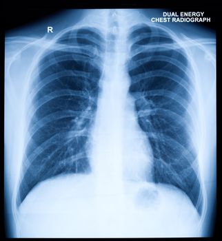 X-Ray Image Of Human Healthy Chest