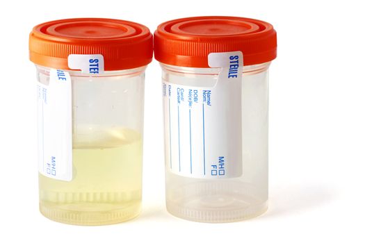 One empty an sterile specimen collection bottle, the other bottle is filled with urine, ready for testing in the laboratory.