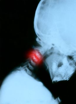 Spine 3rd vertebra xray. Child 3 years. Scanned from the film