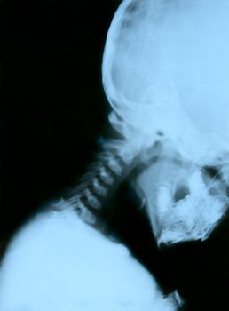 Displacement third vertebra. Child 3 years. Scanned from the film