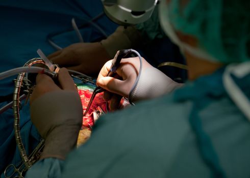 Close-up of doctor performing brain surgery