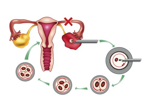diagram illustration of artificial insemination process