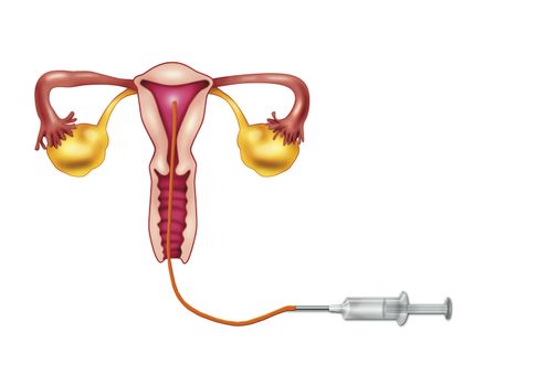 diagram illustration of artificial insemination process