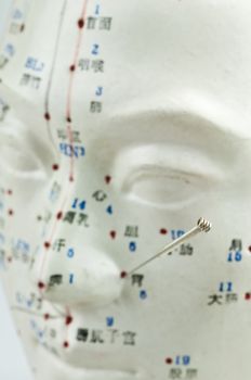 Acupuncture needle