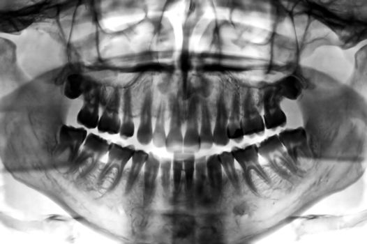 Dental scan x-ray negative of a 35 year old man.