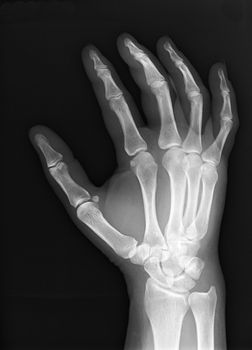 a healthy hand of an X-ray photo