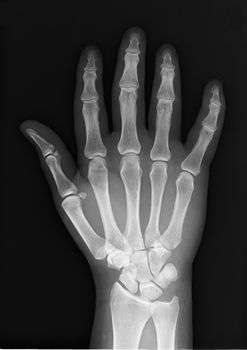 a healthy hand of an X-ray photo