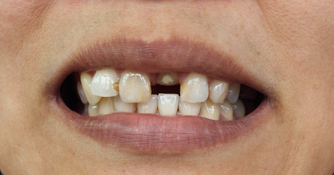 Bad teeth during treat to wait for fasten dentures
