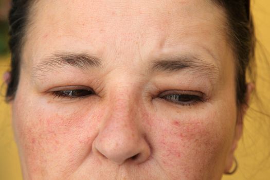 Allergy or conjunctivitis - close-up from a swollen face
