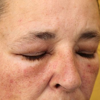 Swollen eyes and face for allergy - close up - Square