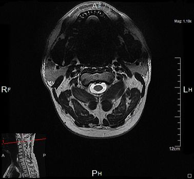 a magnetic resonance imaging of the cervical spine of a human