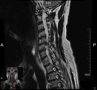 a magnetic resonance imaging of the cervical spine of a human