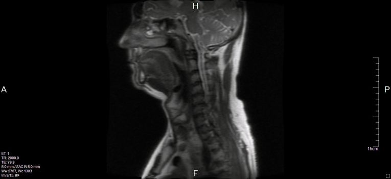 a magnetic resonance imaging of the cervical spine of a human