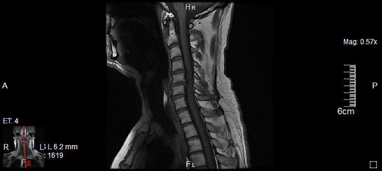 MRT,a magnetic resonance imaging of the cervical spine of a human