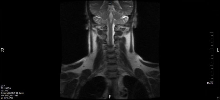 MRT,a magnetic resonance imaging of the cervical spine of a human