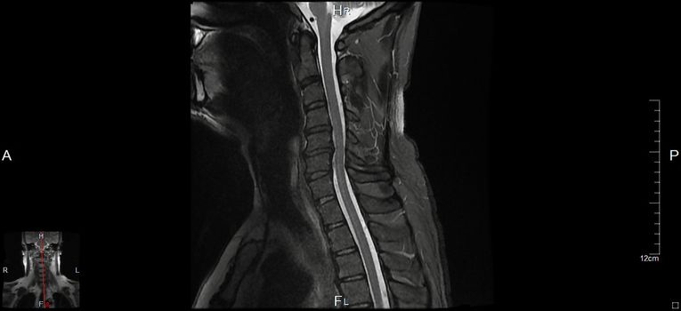 MRT a magnetic resonance imaging of the cervical spine of a human