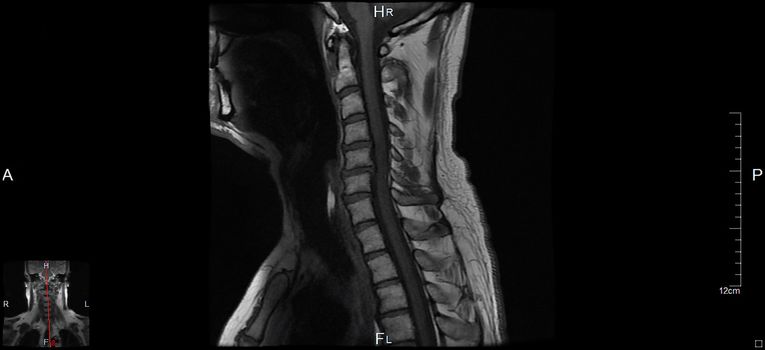 MRT, a magnetic resonance imaging of the cervical spine of a human