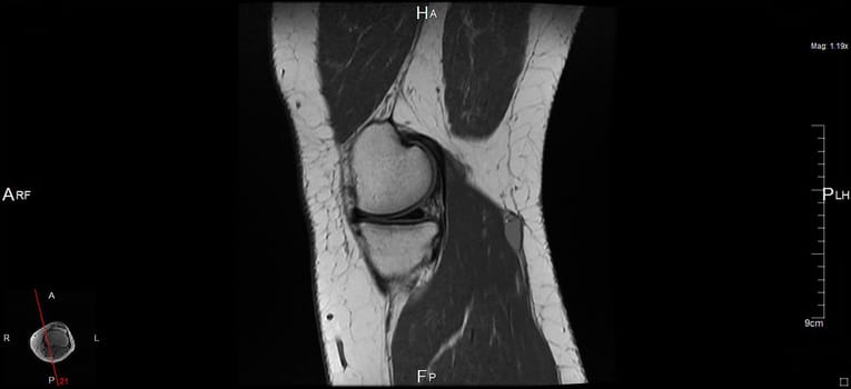 a magnetic resonance imaging
of the left knee, a human