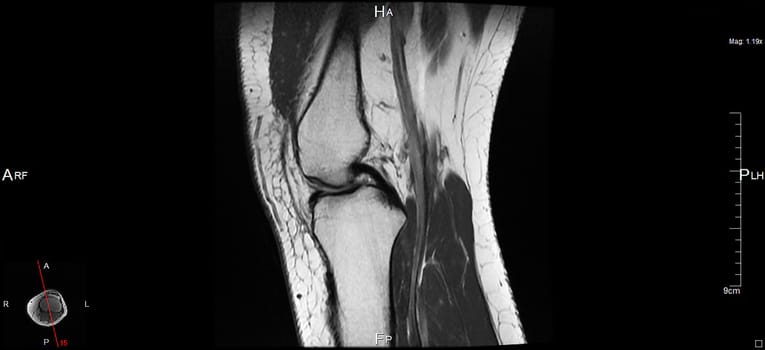 a magnetic resonance imaging
of the left knee, a human