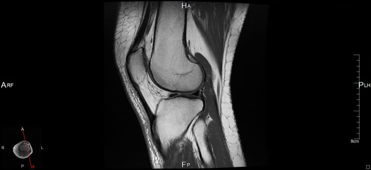 a magnetic resonance imaging
of the left knee, a human