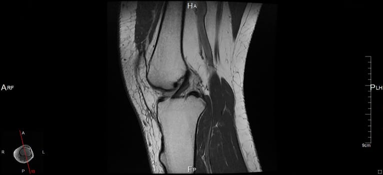 a magnetic resonance imaging
of the left knee, a human