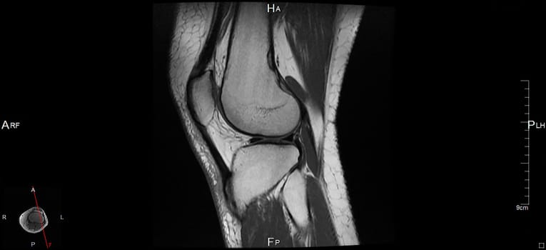 a magnetic resonance imaging
of the left knee, a human