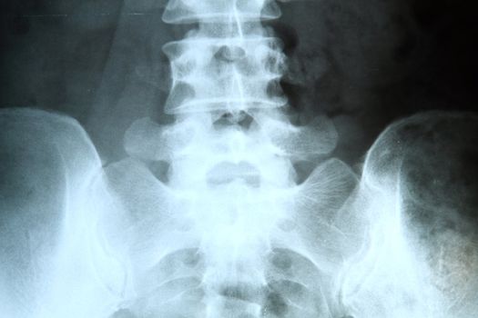 X-ray of the pelvis and spinal column. 