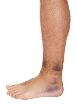 young male with sprained ankle isolated on white background 