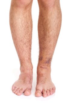 young male with sprained ankle isolated on white background (healthy vs unhealthy)