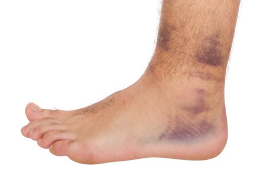 young male with sprained ankle isolated on white background 