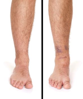 young male with sprained ankle isolated on white background (healthy vs unhealthy)