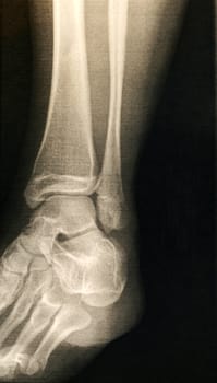 A X-ray of a foot