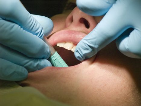 A closeup of a dental hygienist checking a patient's teeth for cavities.