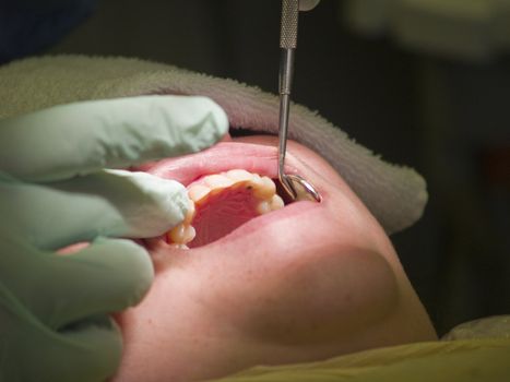 A dentist inspects the open mouth of his patient for cavities in her teeth. Closeup of her top teeth and a filling while the doctor holds her mouth open with a mirror