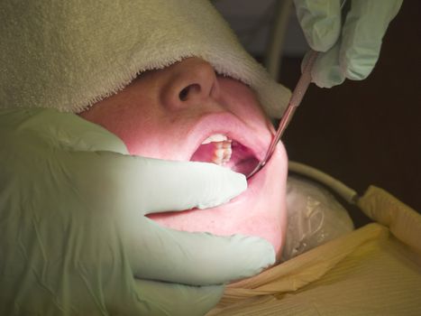 A woman has a painful procedure done at the dentist's office. Closeup of her open mouth and the doctor's hands holding a tool.