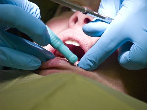 A woman has her teeth cleaned by a dentist before having a root canal done. Closeup shot of her mouth, the doctor's hands and the tools.