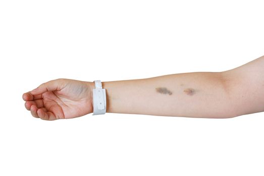 Caucasian women arm with bruises after injections and hospital  wristband isolated on white background