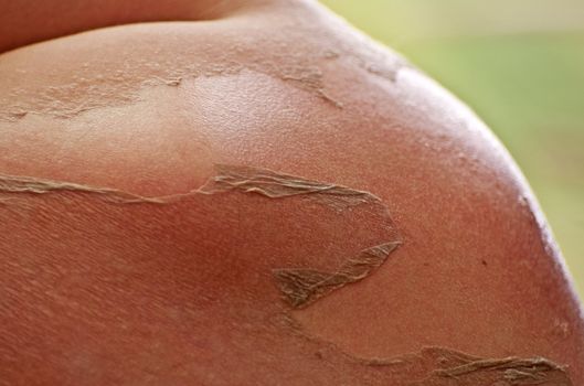 Detail of peeling skin after severe sunburn.