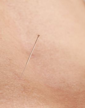 Macro image of an acupuncture needle in the skin of a pacient.