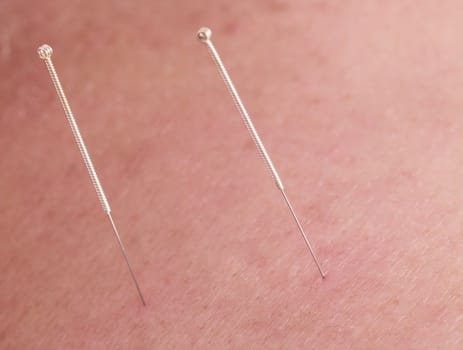 Macro image of two acupuncture needles in the skin of a pacient.