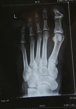 close up of an xray of a foot 