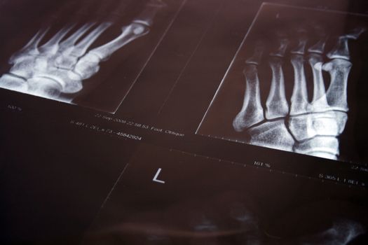 an xray of a foot