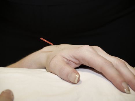 The Eastern or Asian acupuncture medical treatment said to prevent or treat a variety of medical ailments, including pain.