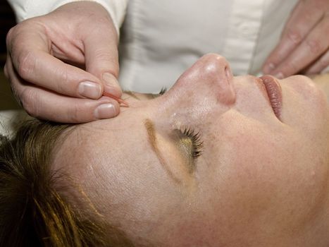 Acupuncture of the face