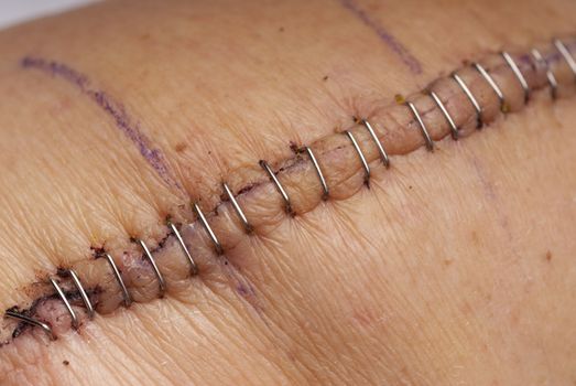 Close up of metal staples used to stitch up a skin in a knee operation