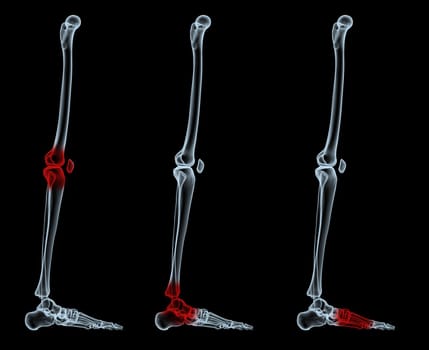 3d rendered scene, x-ray leg with painful area