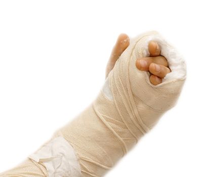 broken arm bone in a cast and bandages over white background isolated