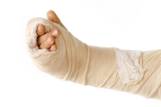 broken arm bone in a cast and bandages over white background isolated