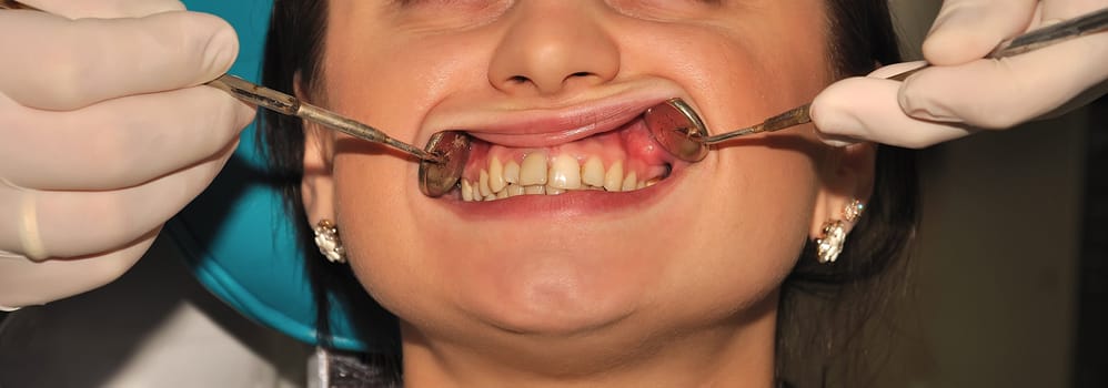 dontist gloved hands holding the patient's lips