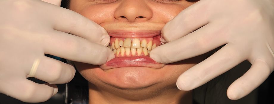 dontist gloved hands holding the patient's lips